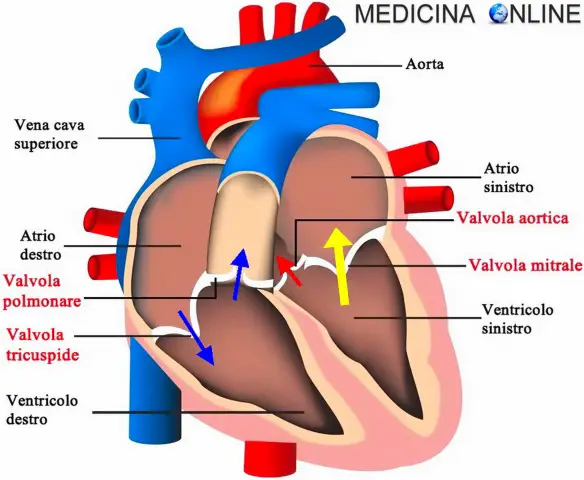 schema del cuore con freccia gialla che indica il reflusso di sangue attraverso la valvola mitralica