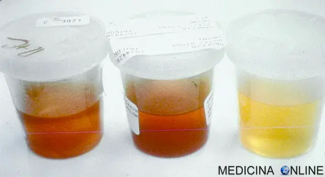 campioni con urina rossa