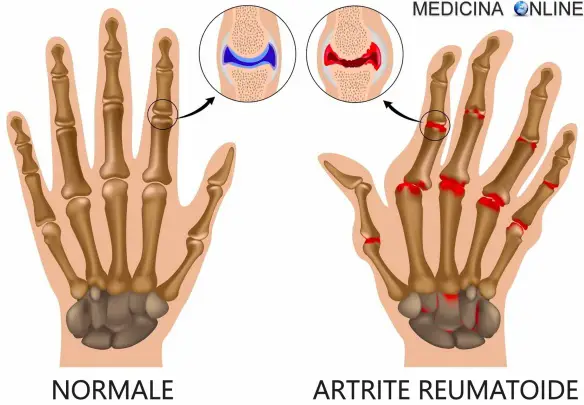 una mano normale e una mano con artrite reumatoide