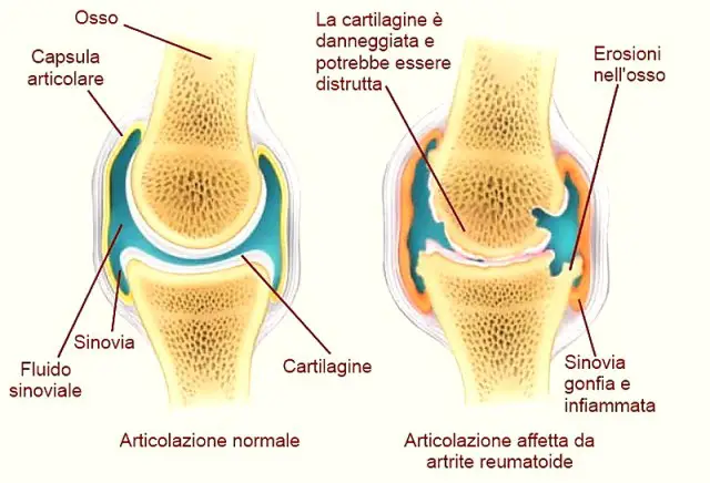 cauze ale durerii în articulația genunchiului la tineri