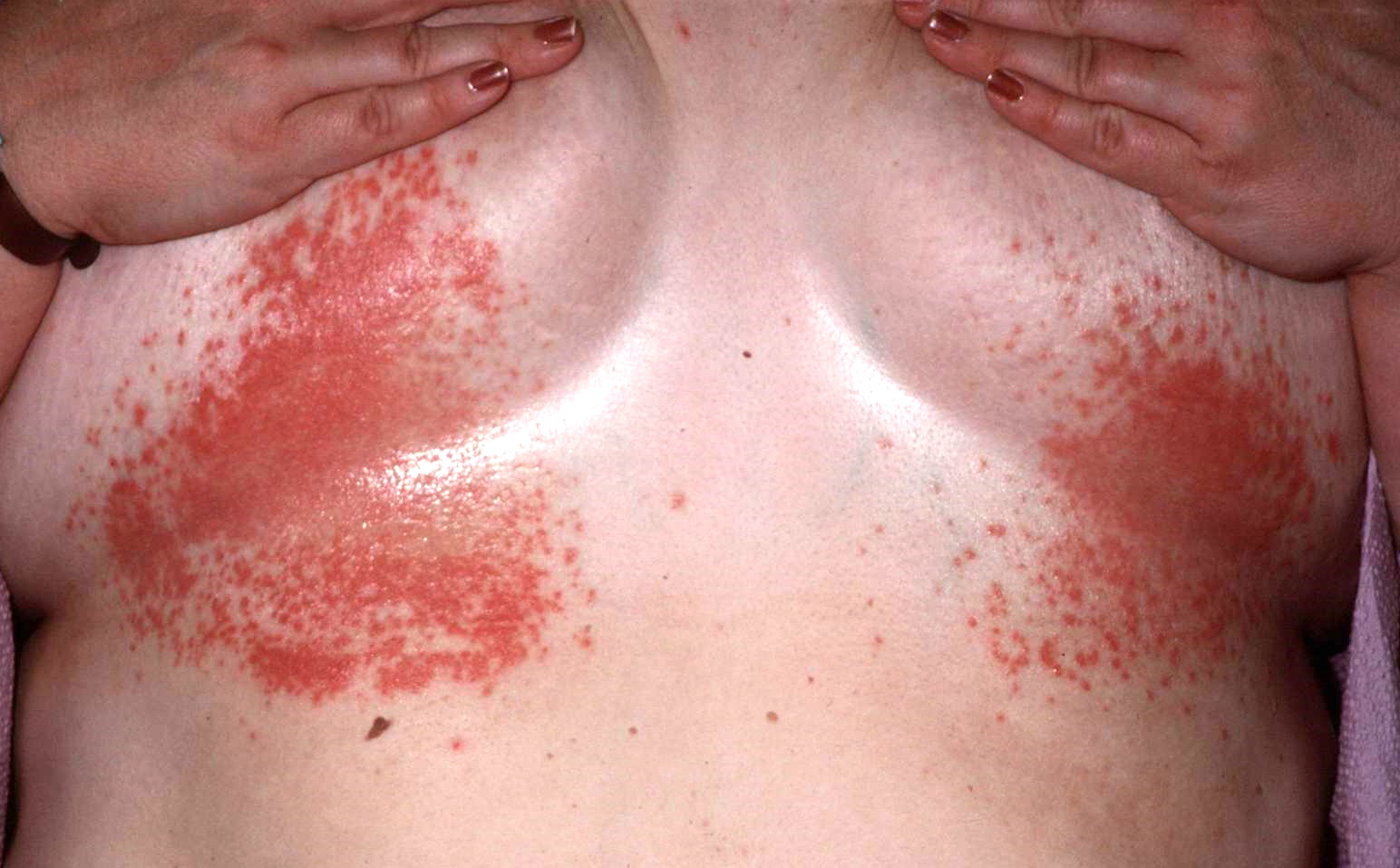 irritazione della pelle da sudore