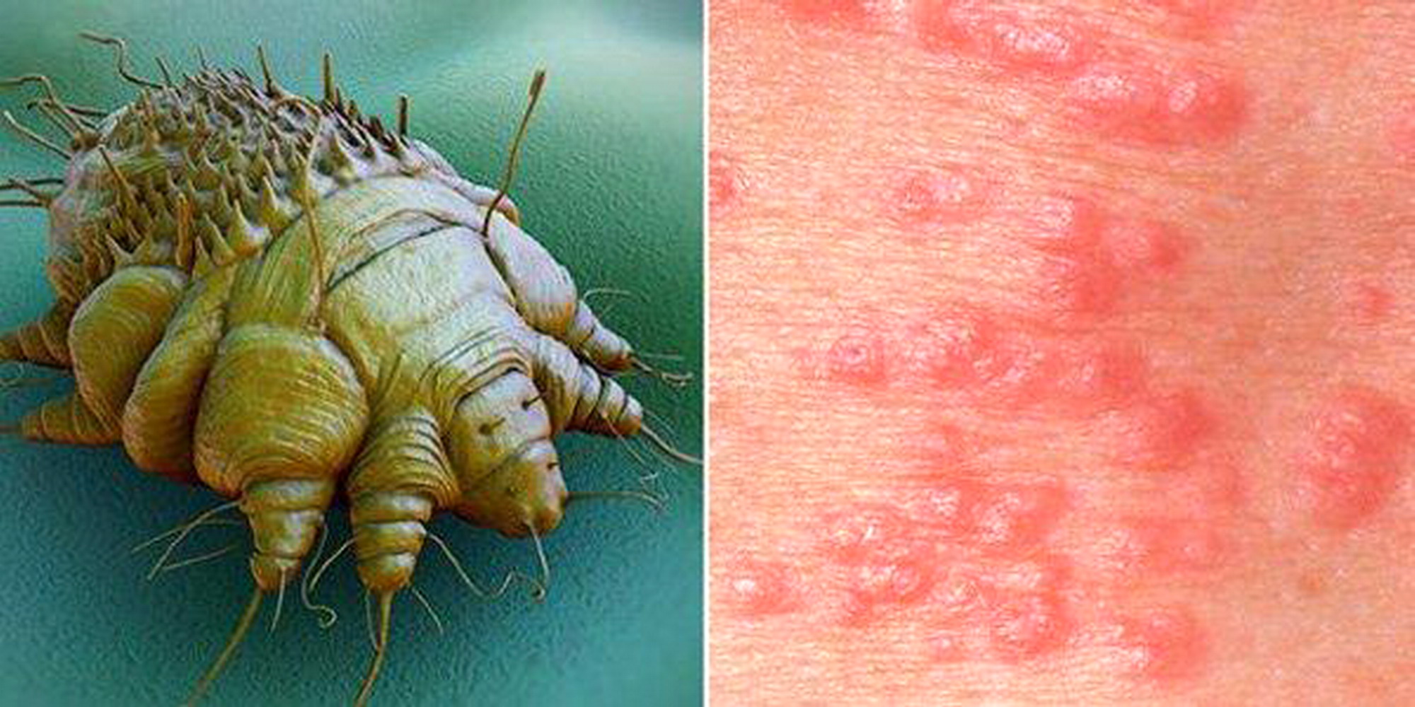 Scabbia su pelle e cuoio capelluto: sintomi, cause e cure
