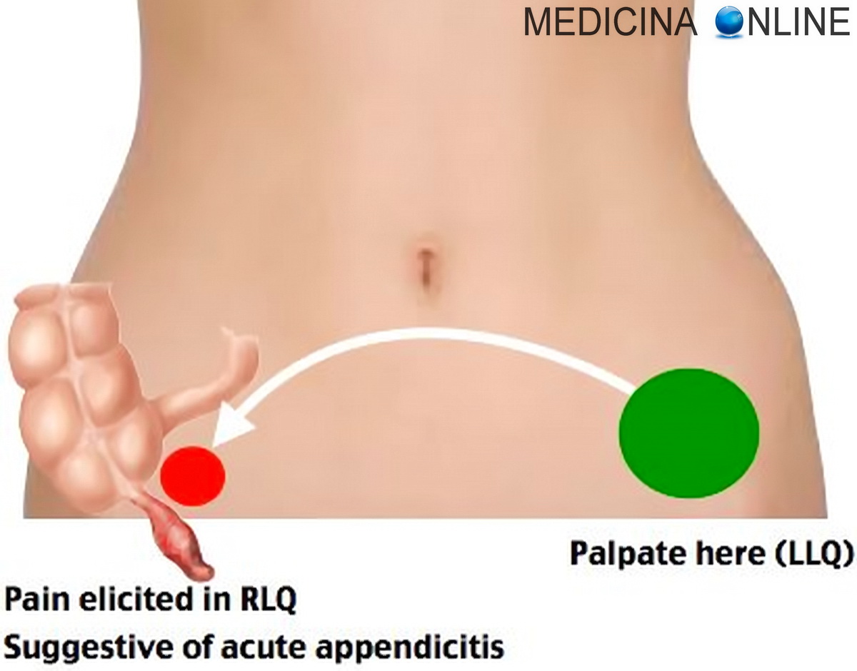 Come sapere se ho l’appendicite