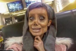 17 MEDICINA ONLINE Sahar Tabar Angelina Jolie Extreme surgery effects