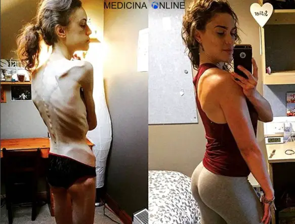 MEDICINA ONLINE ANORESSIA Emelle Lewis Instagram saved my life Anorexic whose weight plummeted to just FIVE stone
