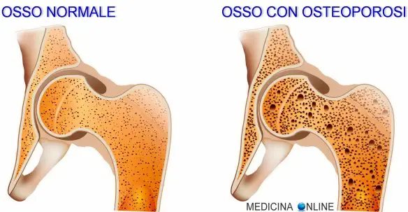 MEDICINA ONLINE FRATTURA OSSO NORMALE FISIOLOGICA TRAUMATICA PATOLOGICA DA STRESS DURATA MICROFRATTURA OSTEOPOROSI METASTASI TUMORE ANZIANO CROLLO VERTEBRA Osteoporose healthy bone pathological fracture.jpg