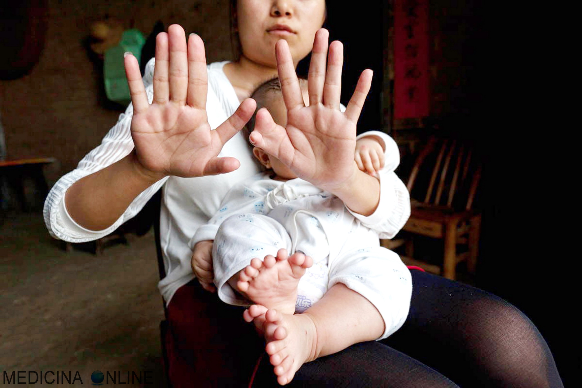 Мама 4 ноги. Полидактилия генная мутация. Дети с шестью пальцами.