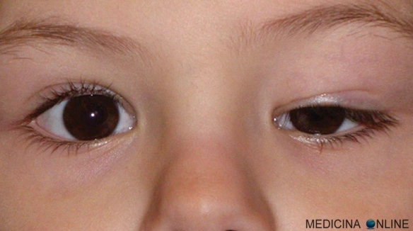 MEDICINA ONLINE PTOSI PALPEBRALE INFANTILE OCCHIO BULBO OCULARE SOPRACCIGLIO MONOLATERALE IMPROVVISA CURA INTERVENTO childhood eyelid ptosis ptosis infantil.jpg