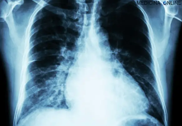 Heart Failure  ( Film X-ray Chest Pa Upright : Show Cardiomegaly