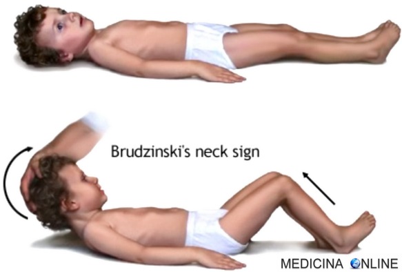 Segno di Brudzinski POSITIVO MENINGITE SEMEIOTICA Brudziński's sign Zeichen Signo Signe de Teken van medical signs meningitis.jpg