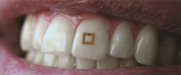 MEDICINA ONLINE Cosa mangi Te lo dice un sensore sui tuoi denti dente.jpg