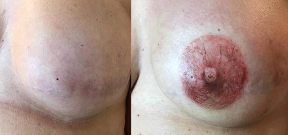 MEDICINA ONLINE Dermopigmentazione di capezzolo e areola eseguita dopo cancro al seno