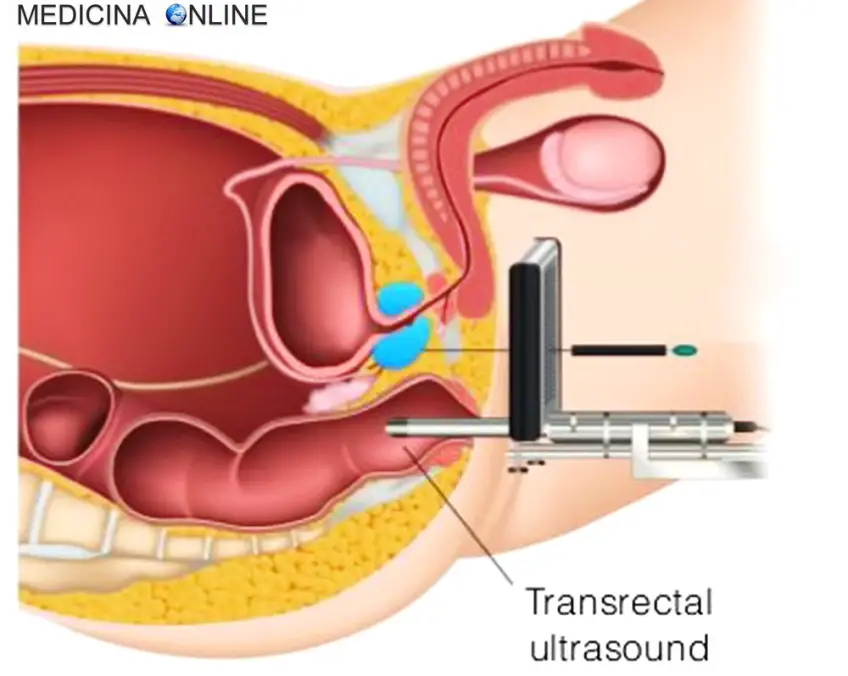 MEDICINA ONLINE BIOPSIA PROSTATICA TRANSPERINEALE prostate biopsy transperineal