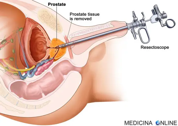 MEDICINA ONLINE BIOPSIA PROSTATICA TRANSURETRALE prostate biopsy transurethral