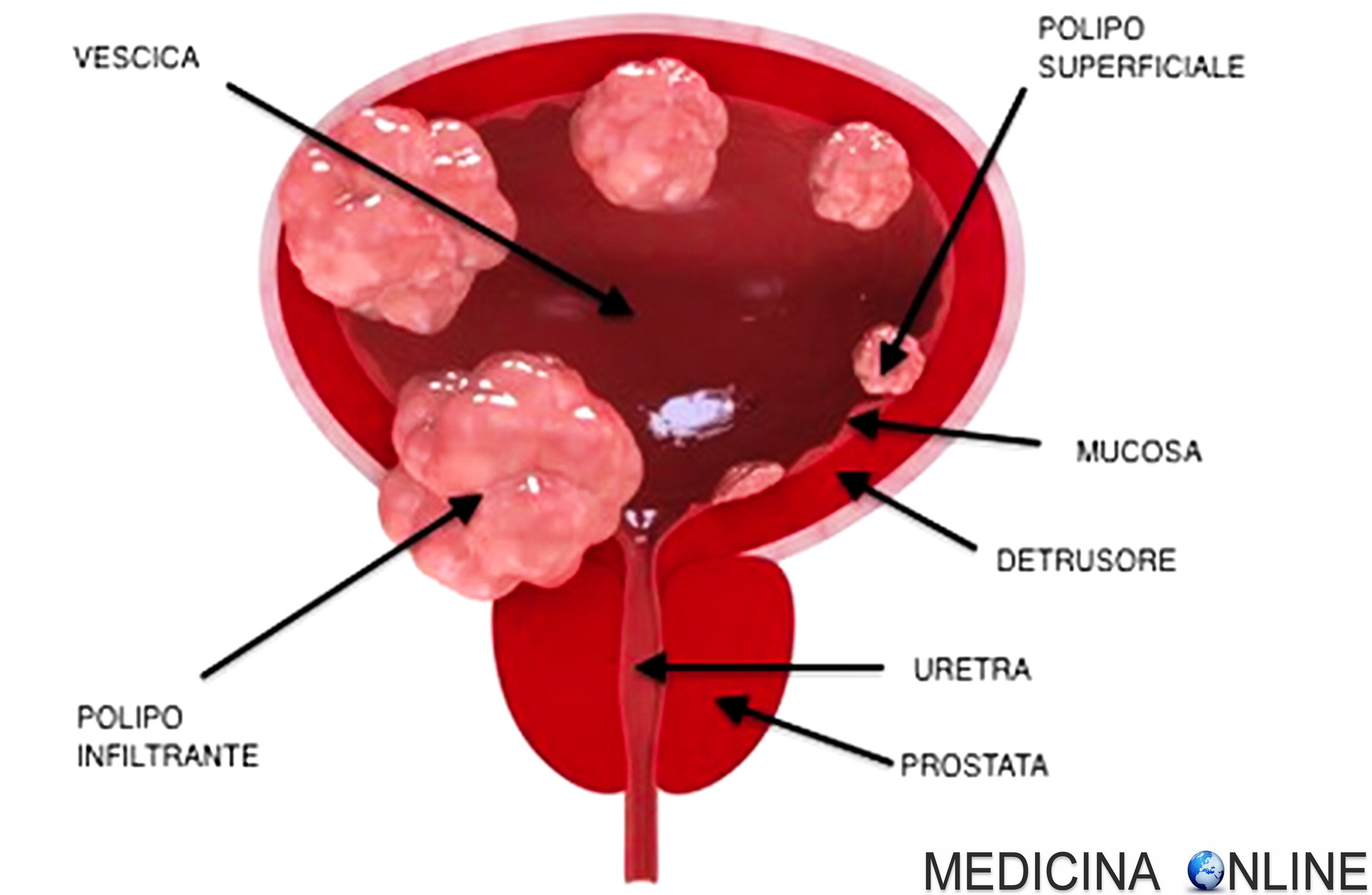 papilloma virus e tumore alla prostata