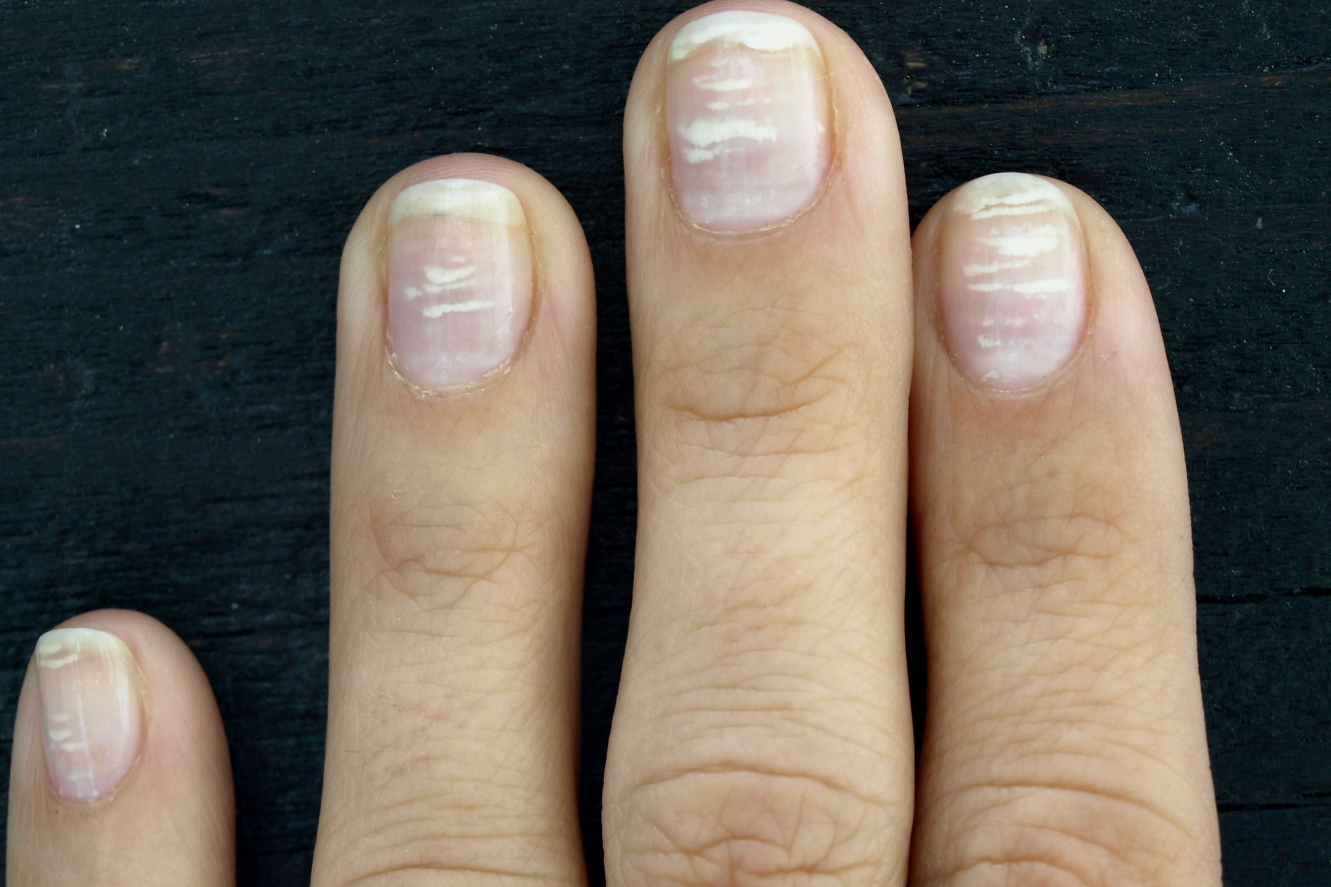 Come eliminare le macchie bianche dalle unghie? | MEDICINA ONLINE