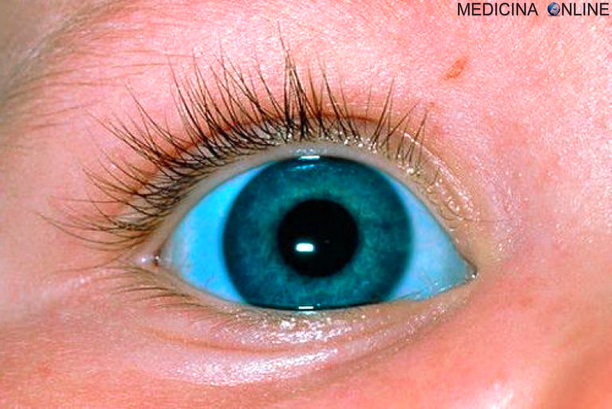 Белки глаз новорожденного. Несовершенный остеогенез склеры.