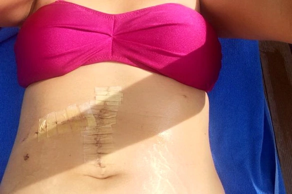 MEDICINA ONLINE Jemma Joslyn scars Turchia acquapark Donna rimane schiacciata sullo scivolo del parco acquatico da una donna obesa rischia la vita.jpg