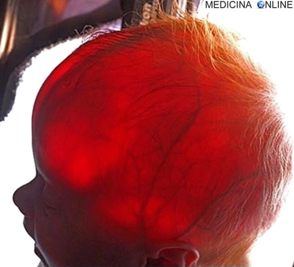 MEDICINA ONLINE Transilluminazione della testa di un neonato per la diagnosi di idrocefalo.jpg
