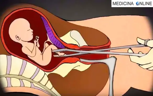 Dott. Emilio Alessio Loiacono Medicina OnLine gravidanza parto incinta raschiamento aborto feto ginecologia neonato settimana legale consenso genitori minorenne