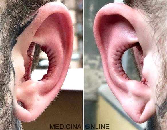 MEDICINA ONLINE Asportazione di parte del padiglione auricolare orecchio una moda pericolosa.jpg