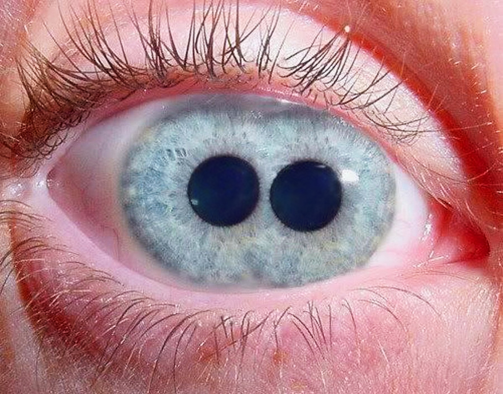Бывает ли двойной. Поликория аномалия глаз.