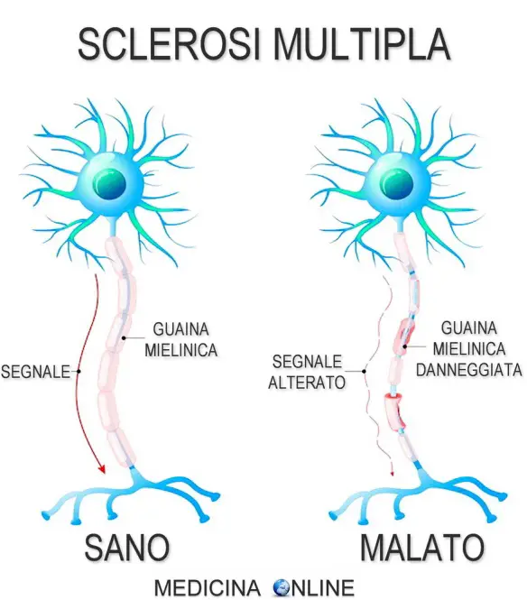 MEDICINA ONLINE SCLEROSI MULTIPLA NEURONE GUAINA MIELINICA SISTEMA NERVOSO.jpg