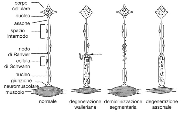 MEDICINA ONLINE Schema dei principali processi patologici che colpiscono i nervi periferici degenerazione walleriana demielinizzazione segmentaria demielinizzazione diffusa degenerazione assonale.jpg