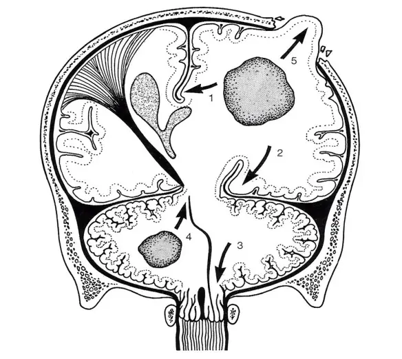 MEDICINA ONLINE Tumore cerebrale Erniazioni cerebrali 1. Il giro del cingolo è dislocato sotto la falce, verso il lato opposto. 2. Le parti inferomediali del lobo temporale sono spinte nella fossa posteriore.jpg