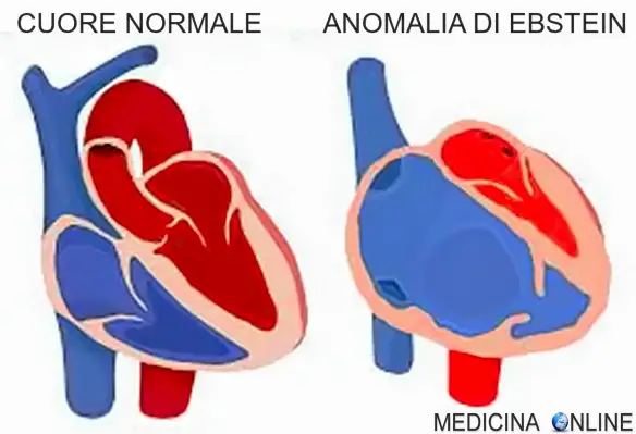 Cuore normale e cuore con anomalia di Ebstein
