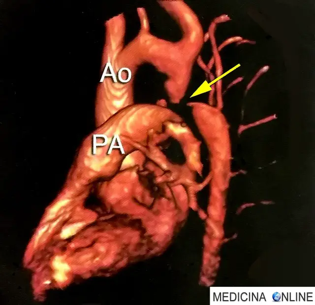 Risonanza magnetica: la freccia gialla indica la coartazione dell'aorta
