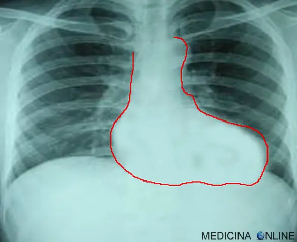 Radiografia del torace di neonato con tetralogia di Fallot: visibile il cuore a zoccolo