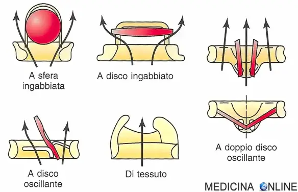 Disegni e schemi di flusso delle principali categorie di protesi valvolari cardiache: protesi valvolari a sfera ingabbiata, a disco ingabbiato, a disco oscillante, a doppio disco oscillante e biologiche (tessuto). Mentre il flusso delle valvole meccaniche deve scorrere lungo entrambi i lati del dispositivo occludente, le protesi biologiche hanno un flusso centrale