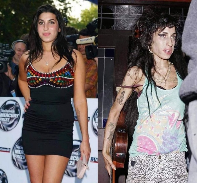 MEDICINA ONLINE EMILIO ALESSIO LOIACONO MEDICO CHIRURGO Amy Winehouse before after drugs alcol dead death