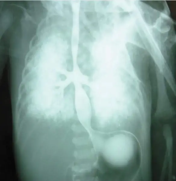 MEDICINA ONLINE EMILIO ALESSIO LOIACONO MEDICO CHIRURGO Radiografia di neonato prematuro con agenesia tracheale