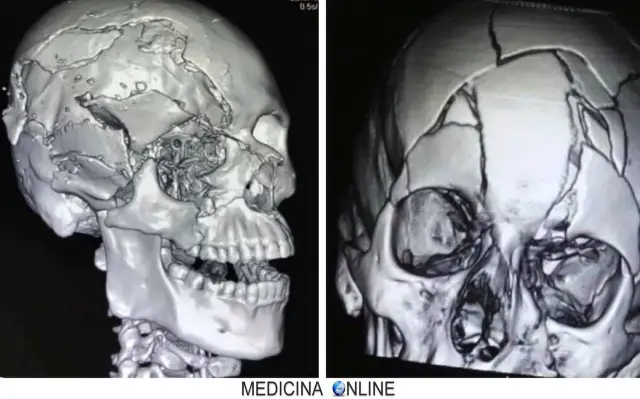 MEDICINA ONLINE Paziente con fratture multiple di varie ossa del cranio in seguito ad incidente stradale