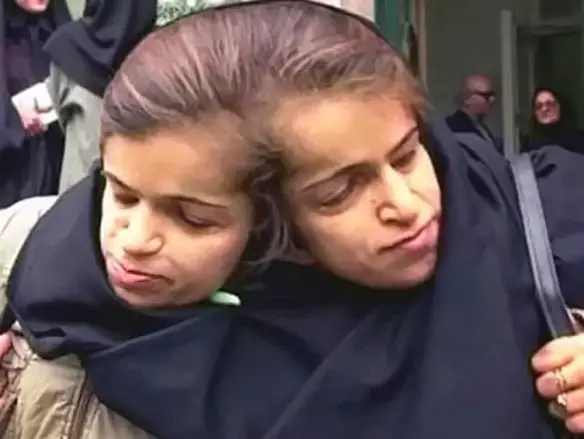 MEDICINA ONLINE Ladan e Laleh Bijani le gemelle siamesi iraniane morte durante l'intervento per separarle