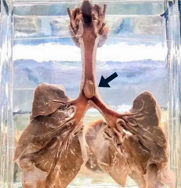 Autopsia di polmoni di bimbo morto per soffocamento da arachide